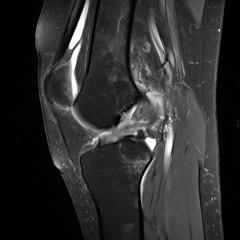 MRI scan showing torn ACL.